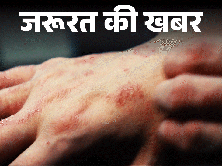 Important News- Skin Infection is Increasing in Monsoon | News of the need- Skin infections increasing in monsoon: bacterial and fungal infections growing moisture, learn tips for rescue and treatment