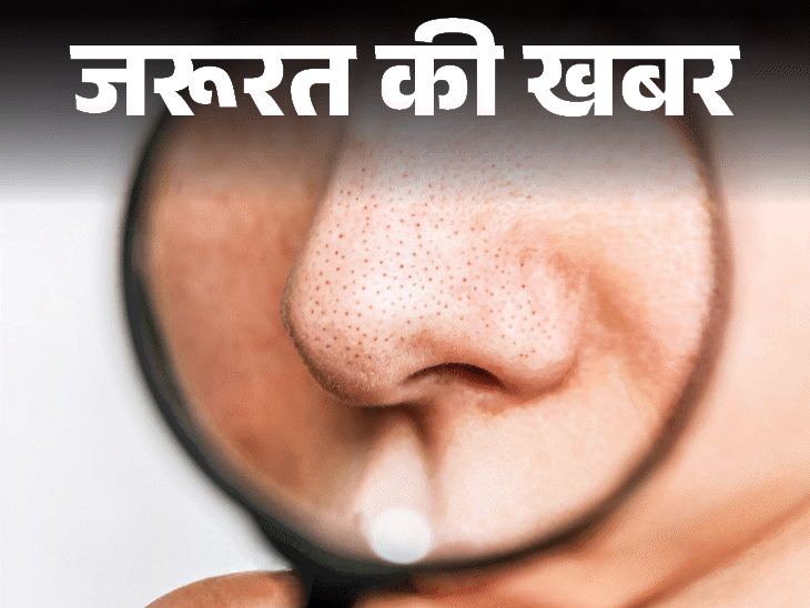 Skin Blackheads Removal Methods; Face wash | Natural oil | News of the need- Blackheads are on your face: These 6 reasons can be, learn 10 tips to get rid of dermatologist